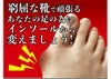 外反母趾対策機能インストール